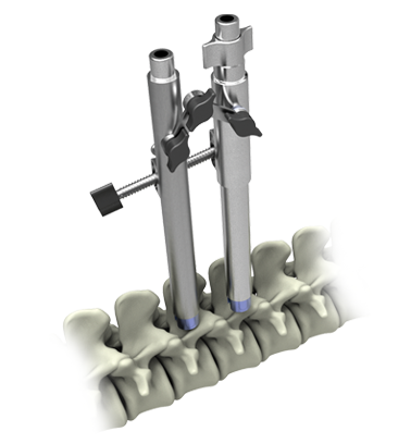 Spinal Fixation System